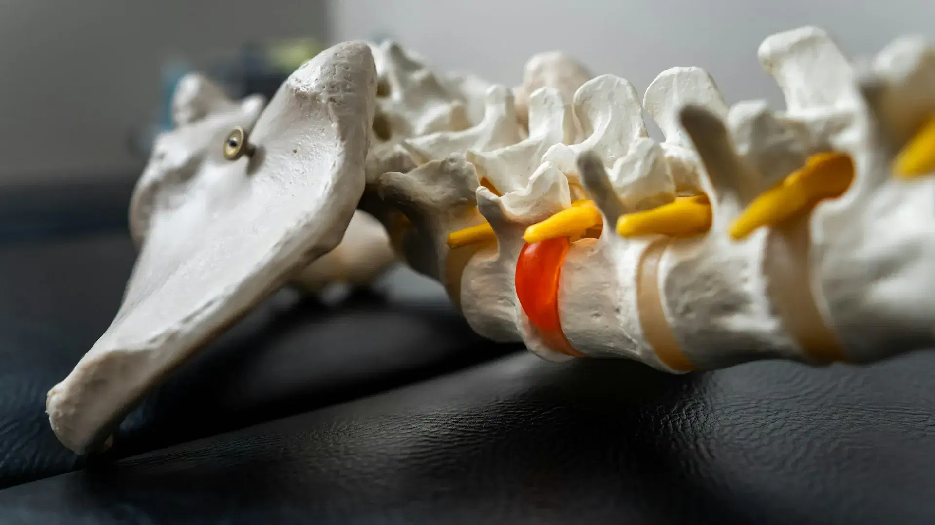 A lumbar spine teaching model, one disc moulded in orange pushing past the rim toward a nerve root.