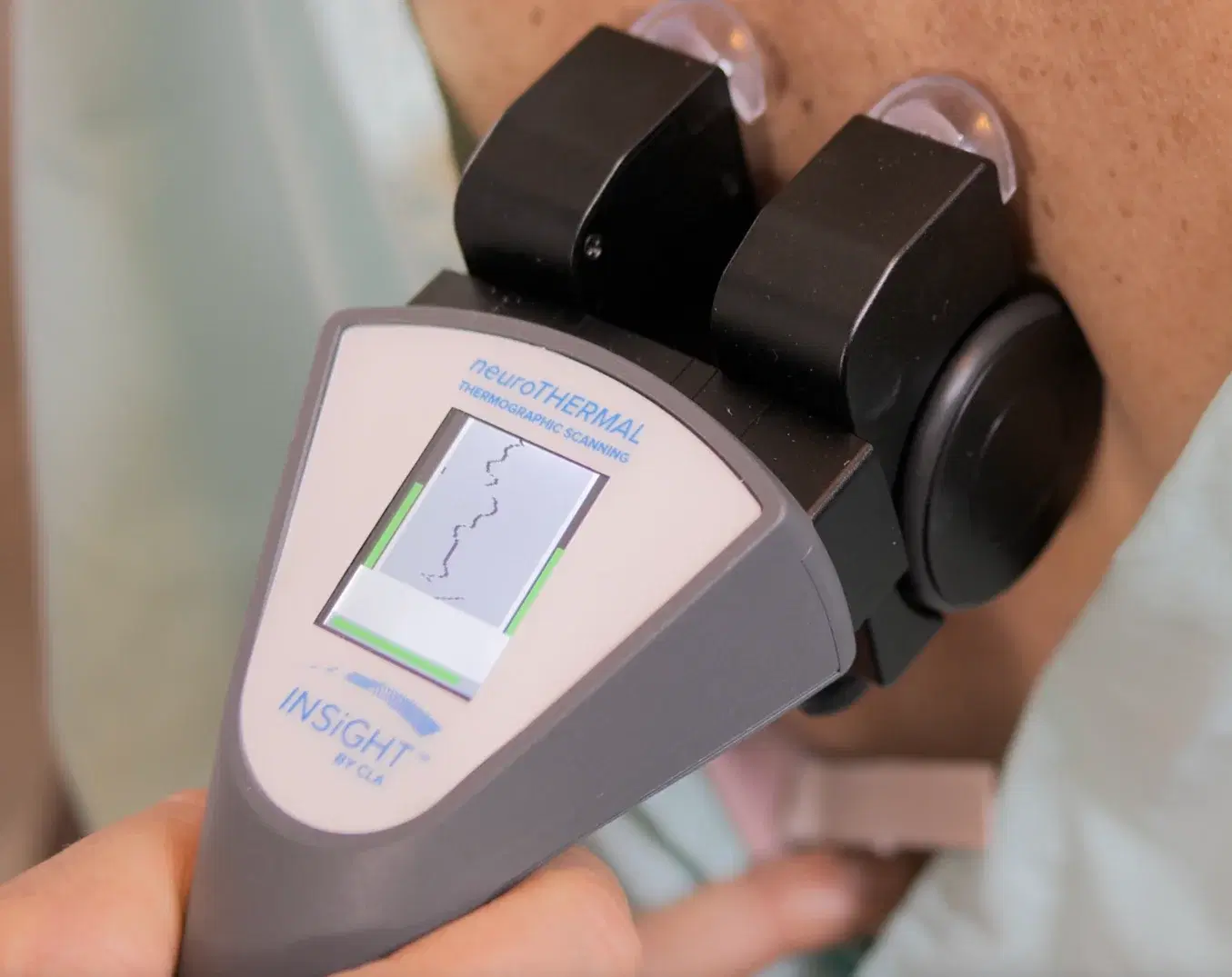 The NeuroTHERMAL unit being run down a patient’s spine.